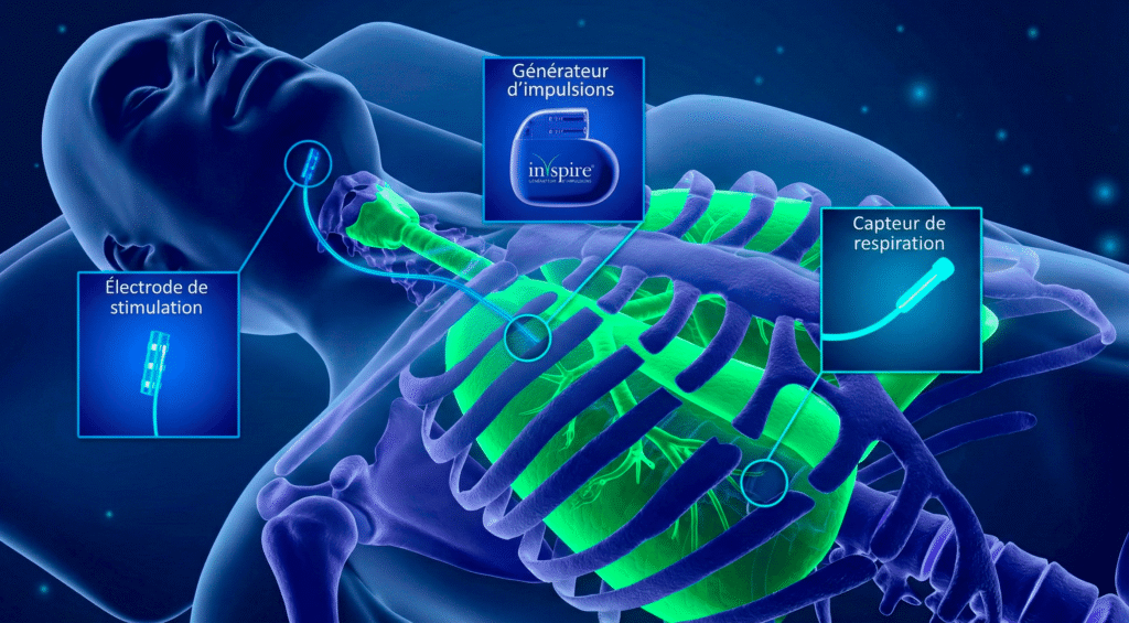 implantation d'un "stimulateur du nerf hypoglosse"